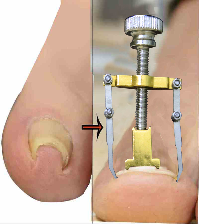 নখের কোনা সোজা করার অত্যাধুনিক যন্ত্র ( Nail Repair